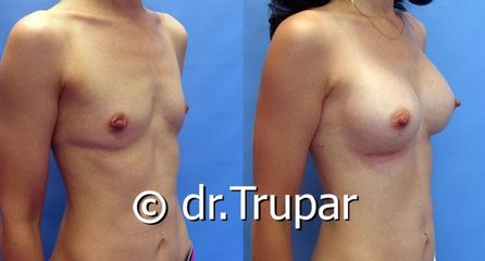 augmentace Trupar 1 0002
