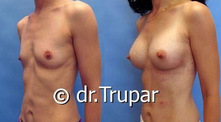augmentace Trupar 1 0003