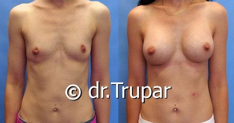 augmentace Trupar 1 0004