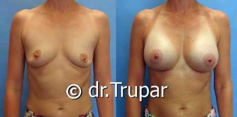 augmentace Trupar 2 0001