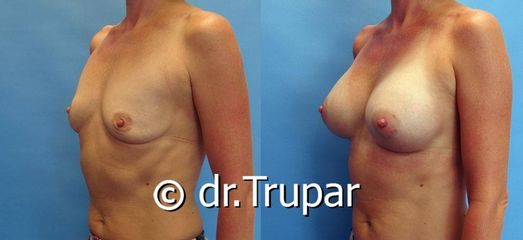 augmentace Trupar 2 0002