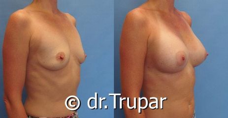augmentace Trupar 2 0003