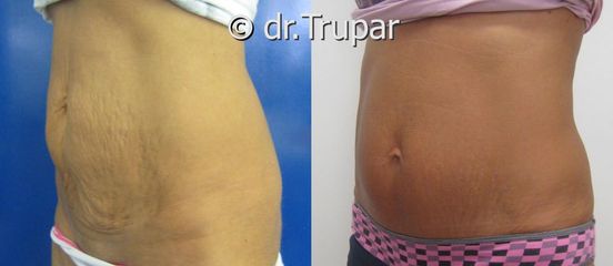 miniabdominoplastika CHI