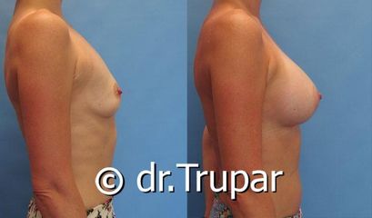 augmentace Trupar 2 0004