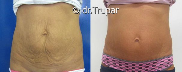 miniabdominoplastika CHI1