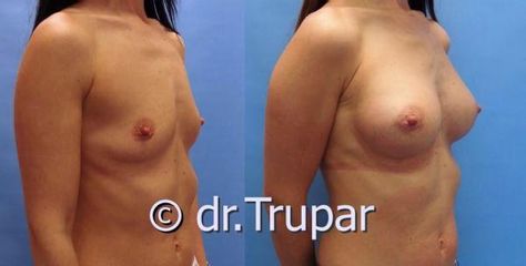 augmentace Trupar 3 0002