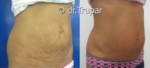 miniabdominoplastika predpo