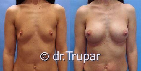 augmentace Trupar 3 0003