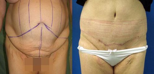 abdominoplastika 3