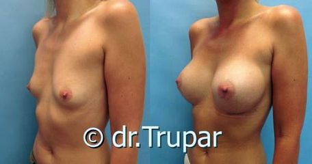 augmentace Trupar 4 0002