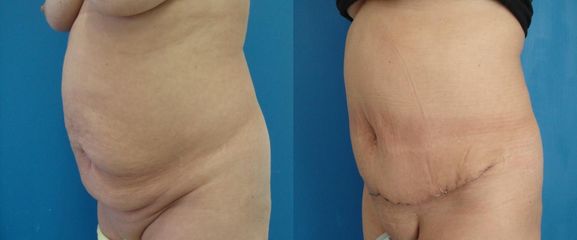 abdominoplastika 2DSC01697 kopie