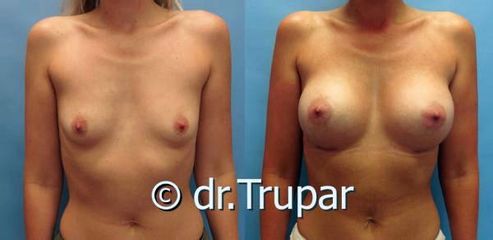 augmentace Trupar 4 0003