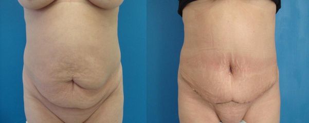 abdominoplastika 2DSC01698 kopie