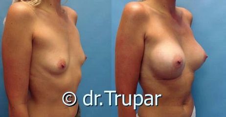 augmentace Trupar 4 0004