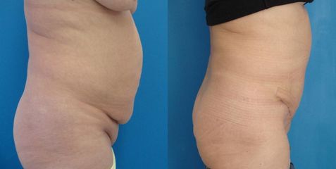 abdominoplastika 2DSC01700 kopie