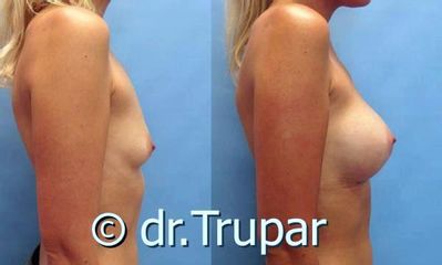 augmentace Trupar 4 0005