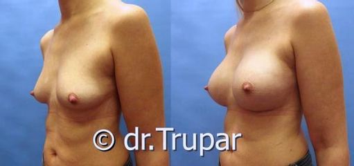 augmentace Trupar 5 0001