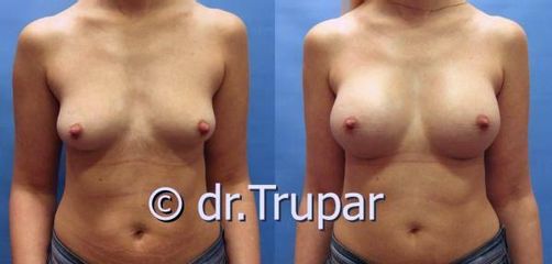 augmentace Trupar 5 0002