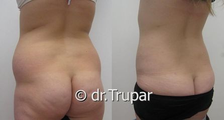 lipo boky predpo1 kopie