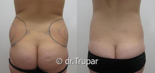 lipo boky predpo2 kopie