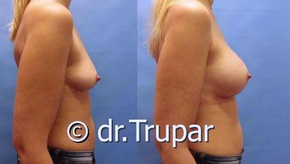 augmentace Trupar 5 0004