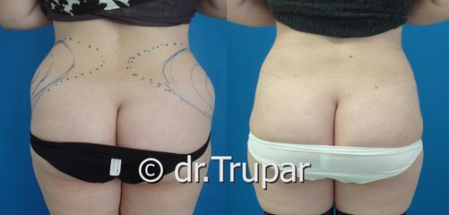 lipo boky SP predpo1 kopie