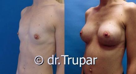 augmentace Trupar 6 0001