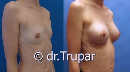 augmentace Trupar 6 0003