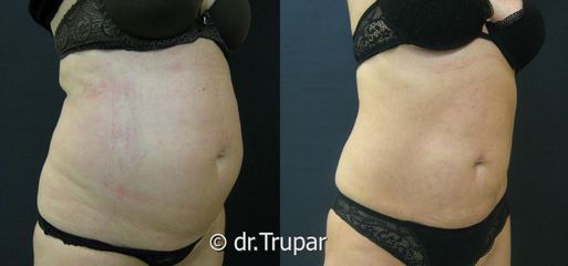 lipo bricha 11a