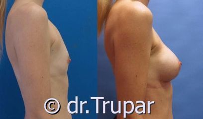 augmentace Trupar 6 0004