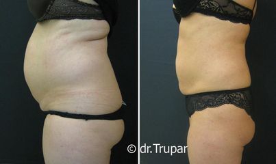 lipo bricha 11b
