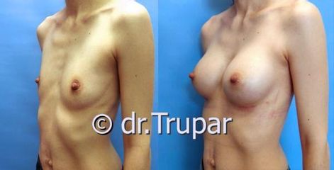 augmentace Trupar 8 0001