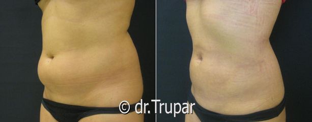 lipo bricho1a kopie