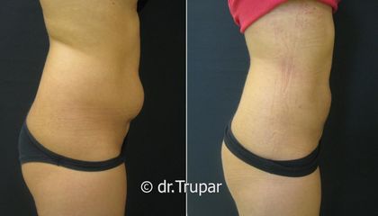 lipo bricho1b kopie