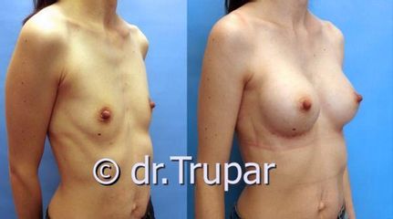 augmentace Trupar 8 0003