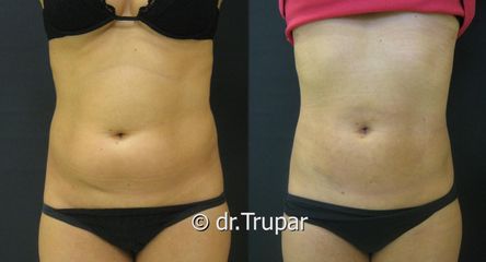 lipo bricho1c kopie