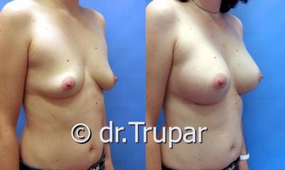 augmentace Trupar 9 0001