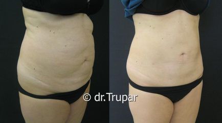 lipo bricho2a kopie