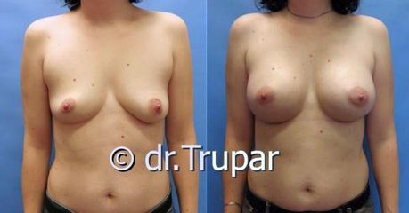 augmentace Trupar 9 0002