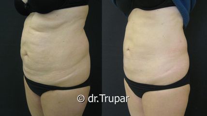 lipo bricho2b kopie