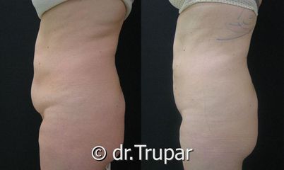 lipo bricho22c