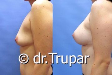 augmentace Trupar 9 0004