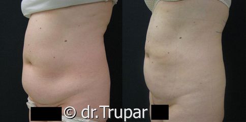 lipo bricho22d