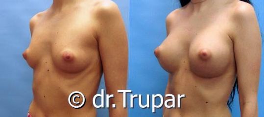 augmentace Trupar 10 0001