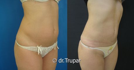 lipo bricho DSC08841 kopie