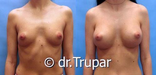 augmentace Trupar 10 0002