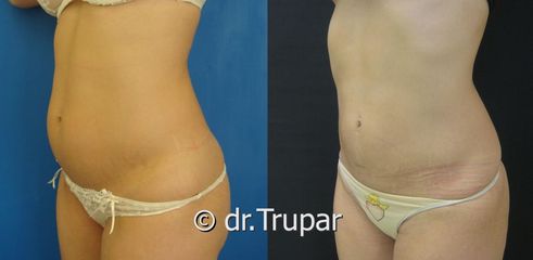 lipo bricho DSC08842 kopie