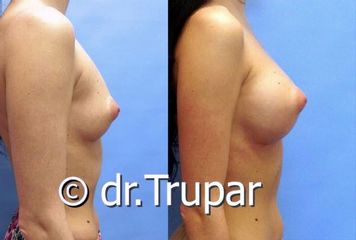 augmentace Trupar 10 0004