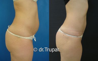 lipo bricho DSC08844 kopie