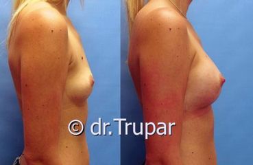 augmentace Trupar 11 0001